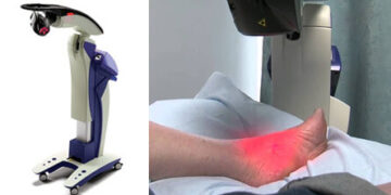 High-Tech Healing – Laser Therapy for Plantar Fasciitis and Carpal Tunnel