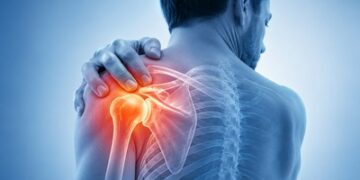 What Is Frozen Shoulder and What Causes It?
